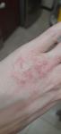 Мелкие, водянистые пузыри на коже рук, сильный зуд и раны фото 2