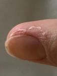 Отслоение и воспаление кожи вокруг ногтей несколько месяцев фото 5