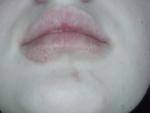 Красное пятно на губах с корками фото 2
