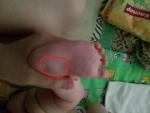 Симметричные шишки на ножках ребенка фото 1