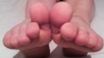 Увеличение передних пальцев на ноге фото 2