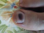 Черное пятно под ногтем ноги фото 1