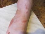 Зудящие красные пятна на ноге фото 1
