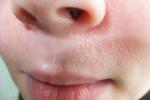 Красная сыпь возле носа и рта фото 1