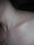 Розовые круглые пятна на спине, шее, груди и плечах фото 2