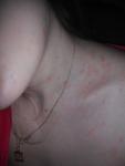 Розовые круглые пятна на спине, шее, груди и плечах фото 1