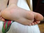 Сыпь на ногах у ребенка фото 3