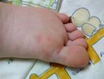Сыпь на ногах у ребенка фото 2