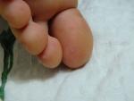 Сыпь на ногах у ребенка фото 5