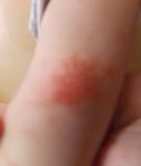 Сыпь на руке у ребенка 11,5 месяцев, сказали, что возможна аллергия фото 1