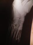 Закрытый перелом основания 5 плюсневой кости фото 1