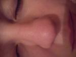 Искривление носовой перегородки операция фото 2