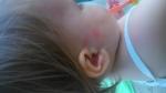 Ребенок 1,5 года аллергия пищевая или на комаров? фото 3