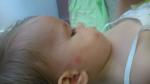 Ребенок 1,5 года аллергия пищевая или на комаров? фото 4