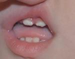 У ребенка рушатся верхние зубы фото 2