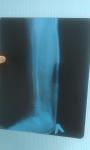 Перелом большой и малой берцовой кости левой ноги фото 2