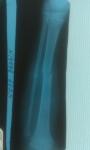 Перелом большой и малой берцовой кости левой ноги фото 3