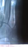 Краевой перелом кости ступни фото 3