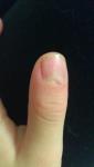 Отслаивание ногтевой пластины у основания большого пальца на руке фото 2