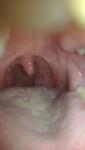 Хронический тонзиллит, заложено ухо, не хватает воздуха фото 1