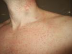 Угревая сыпь (аллергический дерматит) на теле фото 1