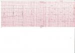 Расшифровка кардиограммы фото 2