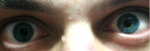 Белые пятна на белках глаз фото 1