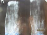 Подголовчатый перелом 5 пястной кости фото 3