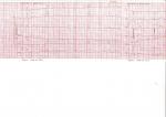 Расшифровка кардиограммы фото 1
