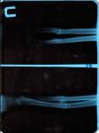 Перелом предплечья, локтевой и лучевой кости фото 1