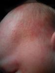 Аллергия или потница у новорожденного фото 1