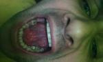 Боль под языком и в горле при глотание фото 1