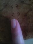 Отслойка ногтя и пятно на руке фото 1