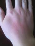 Отслойка ногтя и пятно на руке фото 2