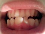 Сломан зуб фото 1