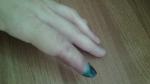 Опух указательный палец на руке через месяц после пореза фото 1