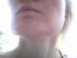 Аллергия или дерматит на лице фото 3