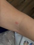 Странные пятна на теле похожие на укус комара чешутся покрываются фото 1