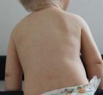 Розовые пятна на спине у ребенка после инфекционной больницы фото 1