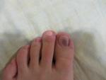 Синеют оба ногтя на больших пальцах на ногах фото 1