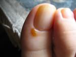 Водянистые пузырьки на пальце ноги фото 1