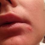 Сыпь с отеком на лице и отеком слизистой носа фото 3