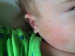 Аллергия и первая вакцинация фото 2