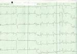 Перебои в работе сердца на кардиограмме фото 1
