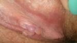 Сыпь между половыми губами фото 1