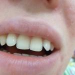 Шерховатая эмаль на зубах фото 1