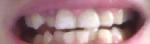 Исправление зубов фото 2