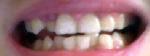 Исправление зубов фото 3