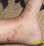 Что это за кожное заболевание, лечение? фото 1
