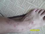 Что это за кожное заболевание, лечение? фото 3